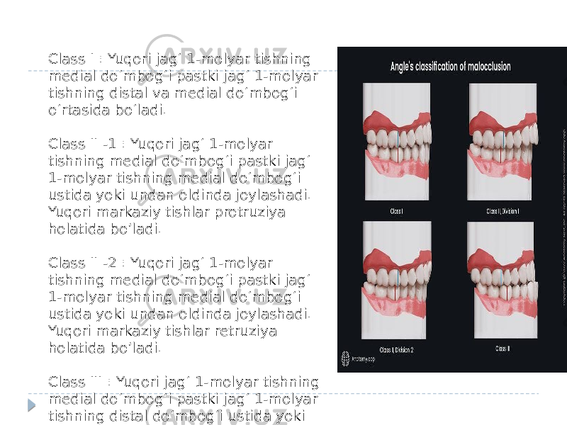 Class I : Yuqori jagʻ 1-molyar tishning medial doʻmbogʻi pastki jagʻ 1-molyar tishning distal va medial doʻmbogʻi oʻrtasida boʻladi. Class II -1 : Yuqori jagʻ 1-molyar tishning medial doʻmbogʻi pastki jagʻ 1-molyar tishning medial doʻmbogʻi ustida yoki undan oldinda joylashadi. Yuqori markaziy tishlar protruziya holatida bo’ladi. Class II -2 : Yuqori jagʻ 1-molyar tishning medial doʻmbogʻi pastki jagʻ 1-molyar tishning medial doʻmbogʻi ustida yoki undan oldinda joylashadi. Yuqori markaziy tishlar retruziya holatida bo’ladi. Class III : Yuqori jagʻ 1-molyar tishning medial doʻmbogʻi pastki jagʻ 1-molyar tishning distal doʻmbogʻi ustida yoki undan orqada joylashadi. 