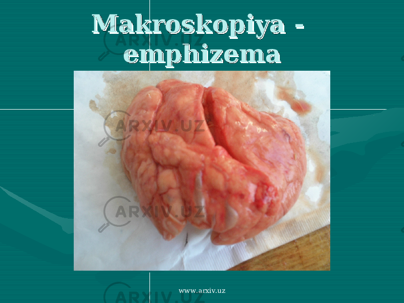 Makroskopiya - Makroskopiya - emphizemaemphizema www.arxiv.uz 