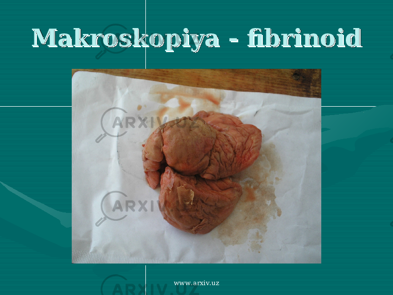 Makroskopiya - fibrinoidMakroskopiya - fibrinoid www.arxiv.uz 