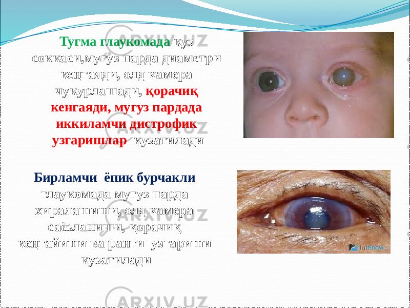 Тугма глаукомада куз соккаси,мугуз парда диаметри кеңгаяди, олд камера чукурлашади, қорачиқ кенгаяди, мугуз пардада иккиламчи дистрофик узгаришлар кузатилади Бирламчи ёпик бурчакли глаукомада мугуз парда хиралашиши, олд камера саёзланиши, қорачиқ кеңгайиши ва ранги узгариши кузатилади 