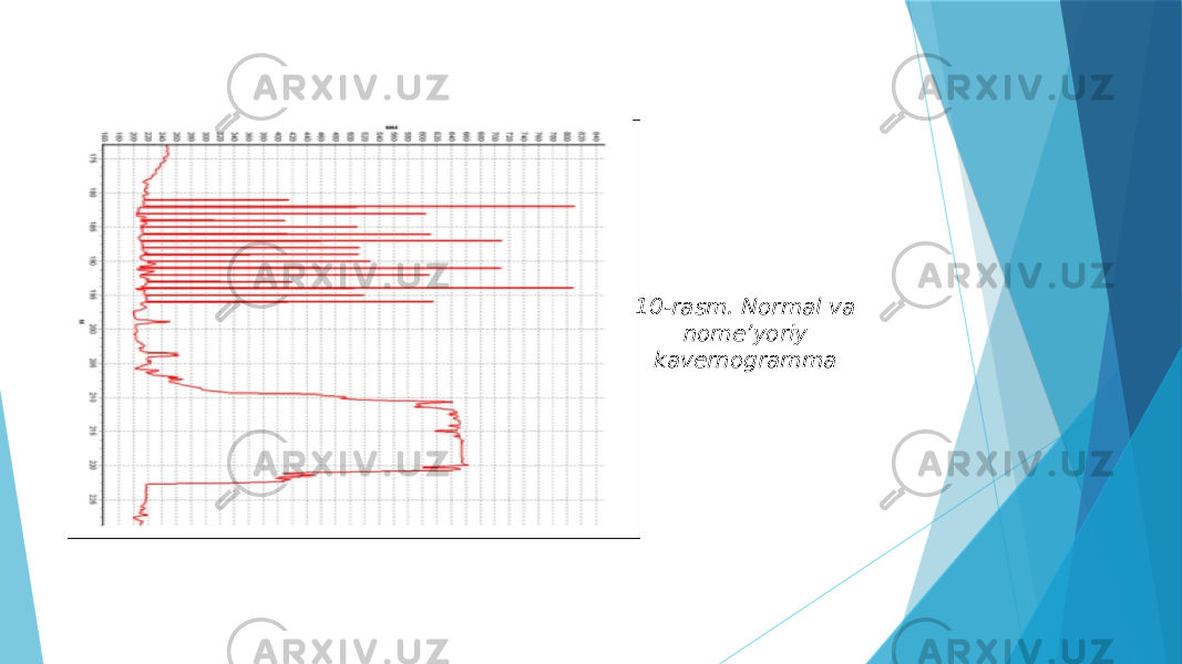 10-rasm. Normal va nome’yoriy kavernogramma 