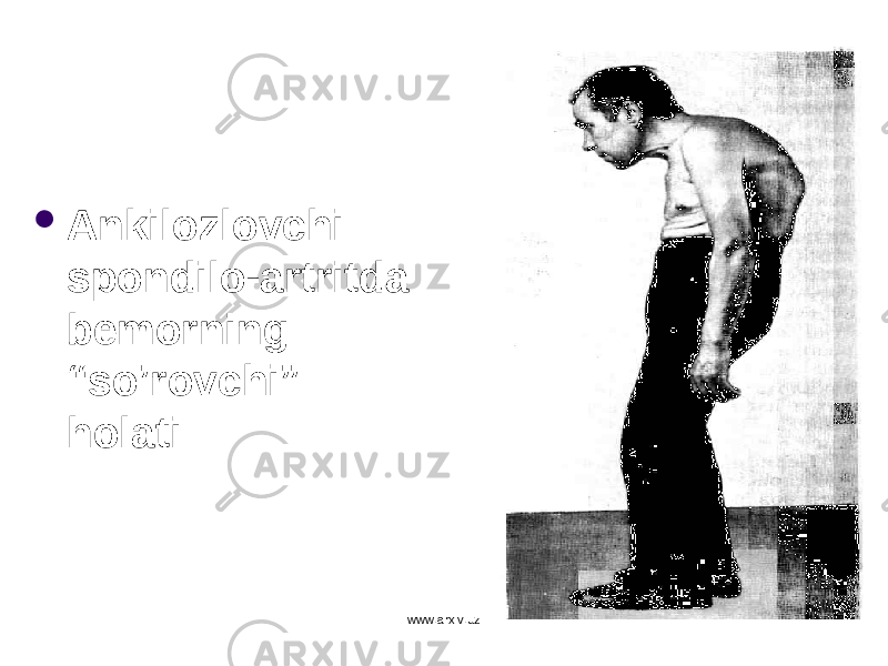  Ankilozlovchi spondilo-artritda bemorning “s o’ rovchi” h olati www.arxiv.uz 