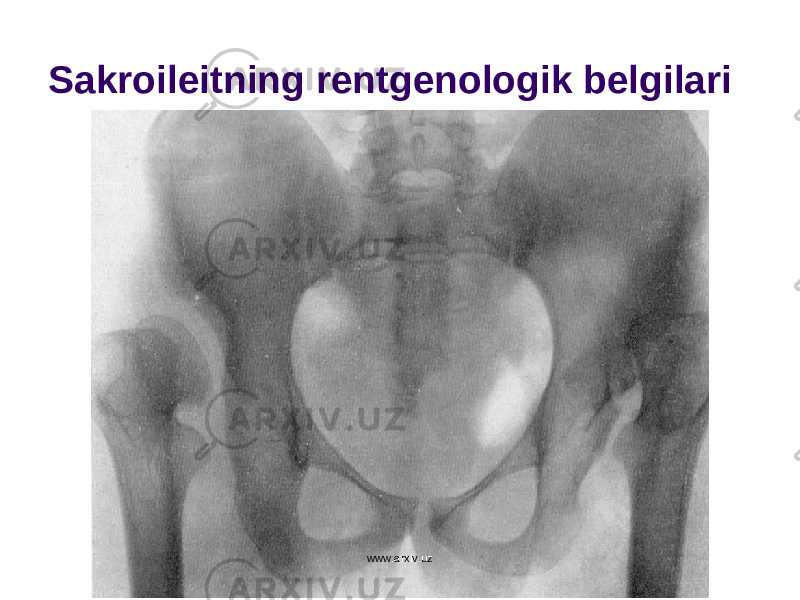 Sakroileitning rentgenologik belgilari www.arxiv.uz 