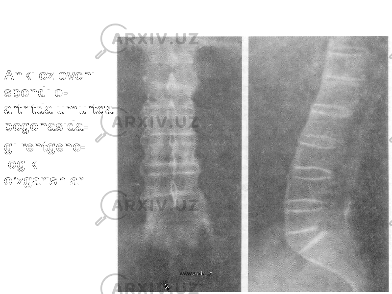 Ankilozlovchi spondilo- artritda umurt q a po g onasida- gi rentgeno- logik o’ zgarishlar www.arxiv.uz 