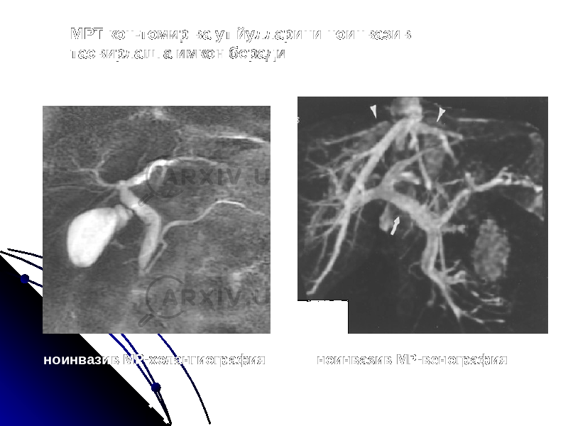 ноинвазив МР-холангиография МРТ кон-томир ва ут йулларини ноинвазив тасвирлашга имкон беради ноинвазив МР-венография 