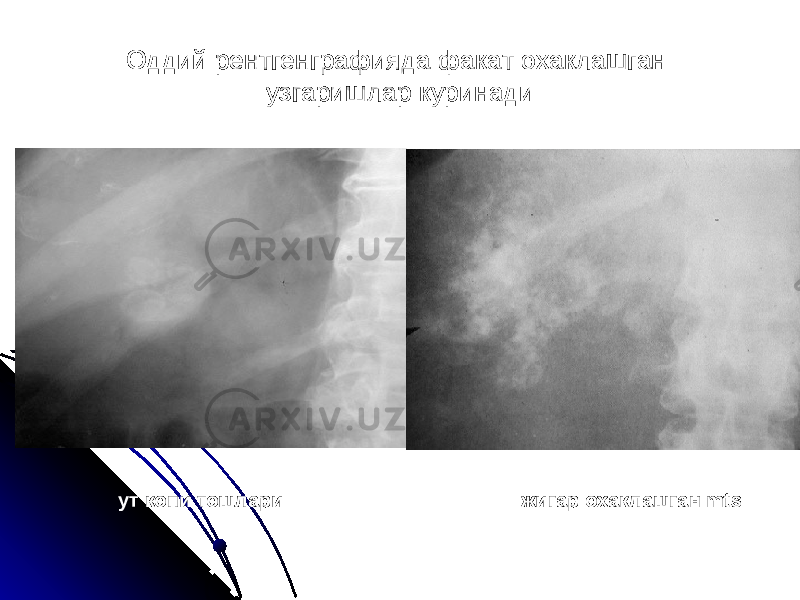 Оддий рентгенграфияда факат охаклашган узгаришлар куринади ут копи тошлари жигар охаклашган mts 