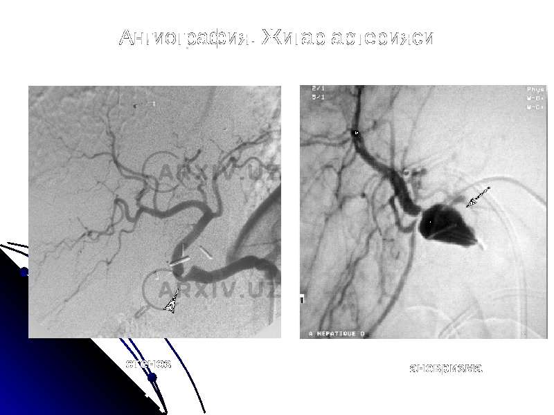 Ангиография. Жигар артерияси стеноз аневризма 