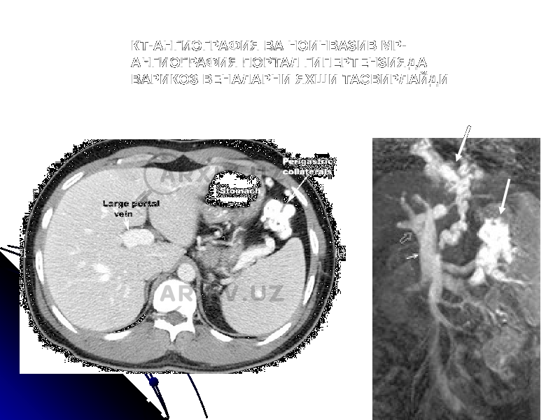 КТ-АНГИОГРАФИЯ ВА НОИНВАЗИВ МР- АНГИОГРАФИЯ ПОРТАЛ ГИПЕРТЕНЗИЯДА ВАРИКОЗ ВЕНАЛАРНИ ЯХШИ ТАСВИРЛАЙДИ 