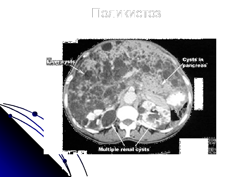 Поликистоз 