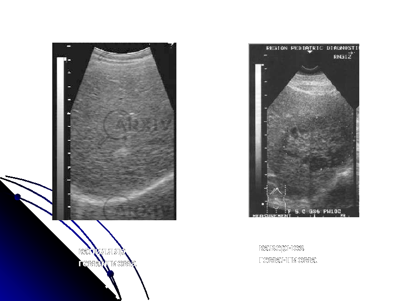 каверноз гемангиомакапилляр гемангиома 