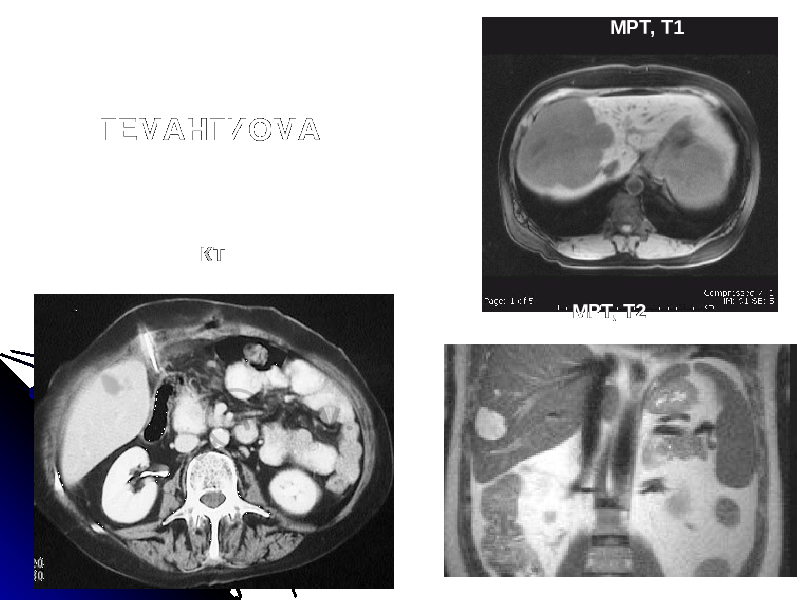 ГЕМАНГИОМА КТ МРТ, Т1 МРТ, Т2 