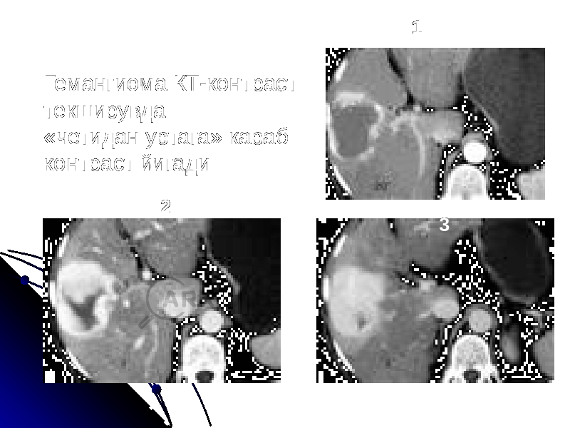 Гемангиома КТ-контраст текширувда «четидан уртага» караб контраст йигади 1 2 3 