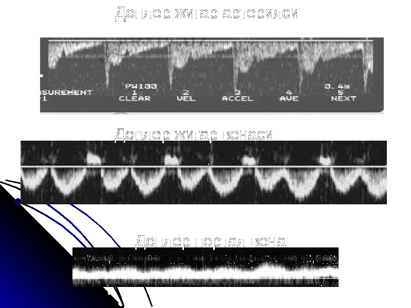Доплер жигар артерияси Доплер жигар венаси Доплер портал вена 