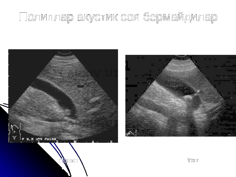 Полиплар акустик соя бермайдилар Полип Тош 