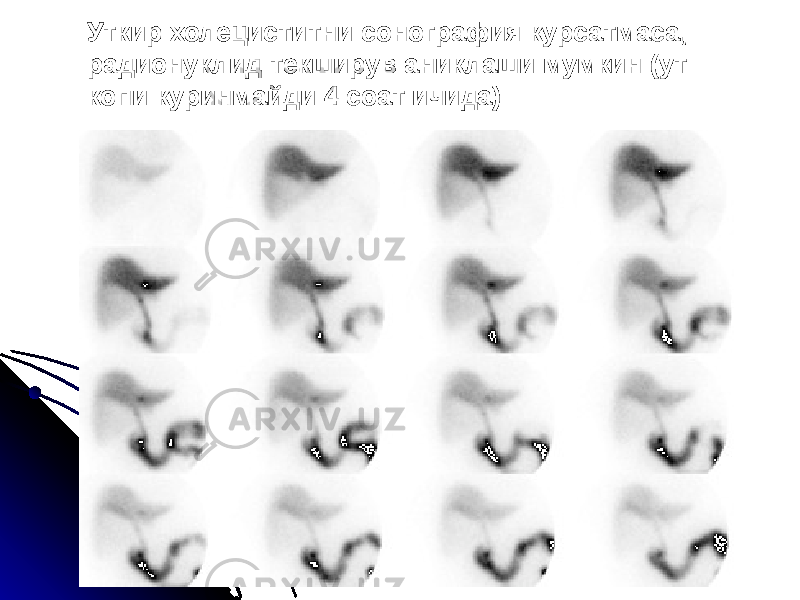 Уткир холециститни сонография курсатмаса, радионуклид текширув аниклаши мумкин (ут копи куринмайди 4 соат ичида) 