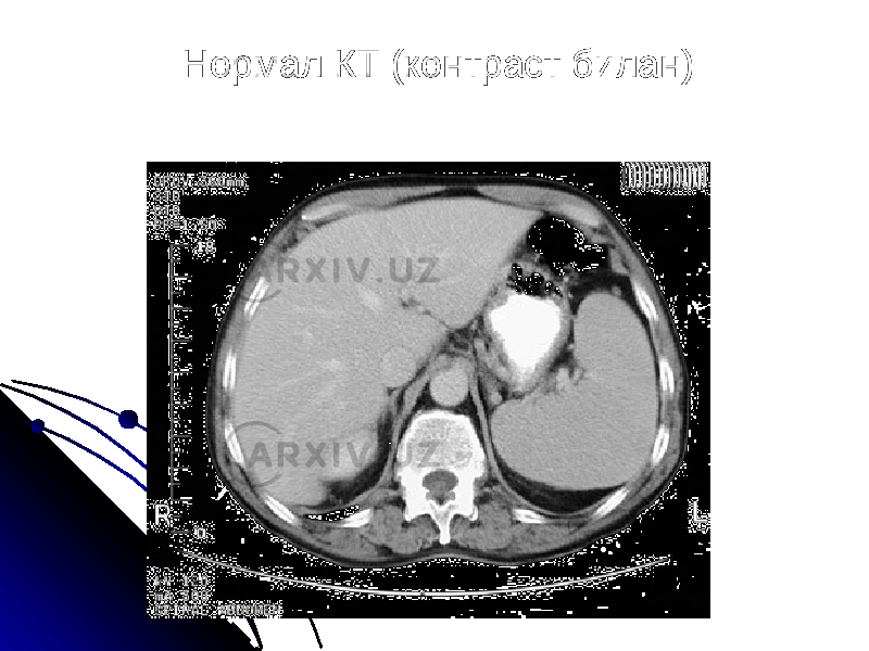 Нормал КТ (контраст билан) 