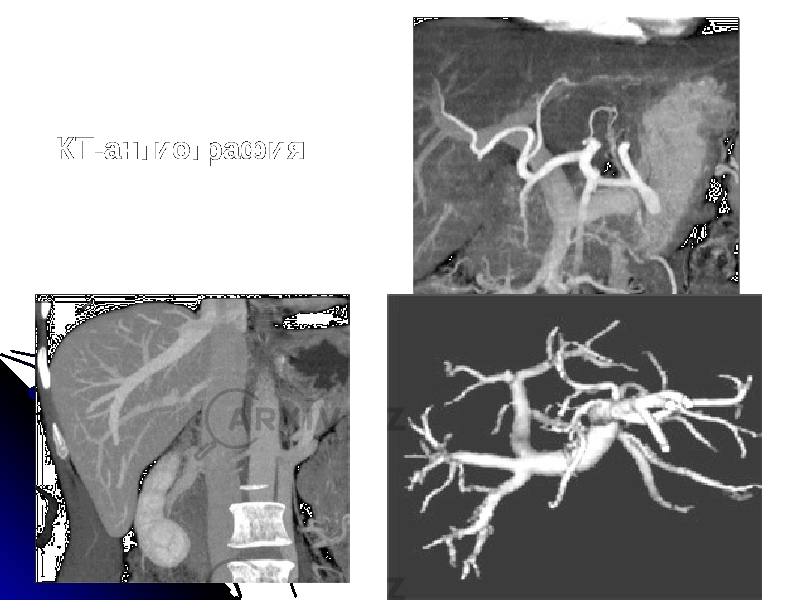 КТ-ангиография 