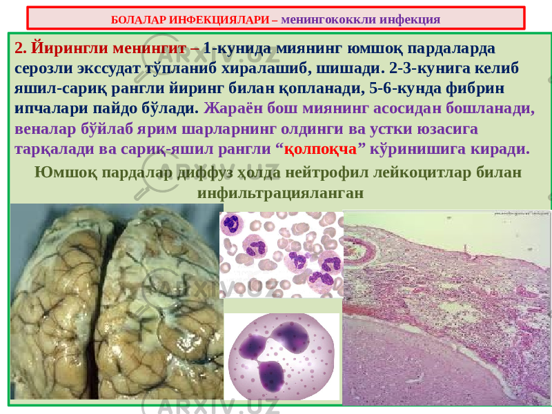 2. Йирингли менингит – 1-кунида миянинг юмшоқ пардаларда серозли экссудат тўпланиб хиралашиб, шишади. 2-3-кунига келиб яшил-сариқ рангли йиринг билан қопланади, 5-6-кунда фибрин ипчалари пайдо бўлади. Жараён бош миянинг асосидан бошланади, веналар бўйлаб ярим шарларнинг олдинги ва устки юзасига тарқалади ва сариқ-яшил рангли “ қолпоқча ” кўринишига киради. Юмшоқ пардалар диффуз ҳолда нейтрофил лейкоцитлар билан инфильтрацияланганБОЛАЛАР ИНФЕКЦИЯЛАРИ – менингококкли инфекция 