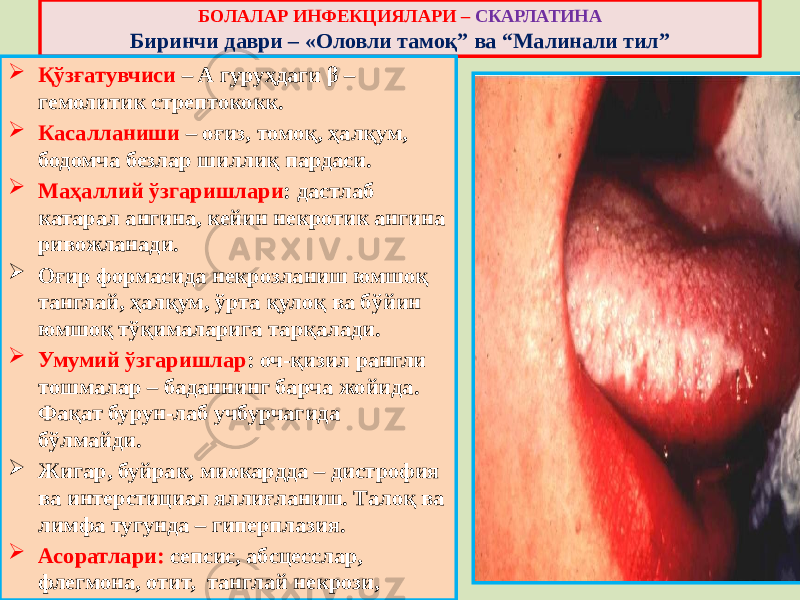 БОЛАЛАР ИНФЕКЦИЯЛАРИ – СКАРЛАТИНА Биринчи даври – «Оловли тамоқ” ва “Малинали тил”  Қўзғатувчиси – А гуруҳдаги β – гемолитик стрептококк.  Касалланиши – оғиз, томоқ, ҳалқум, бодомча безлар шиллиқ пардаси.  Маҳаллий ўзгаришлари : дастлаб катарал ангина, кейин некротик ангина ривожланади.  Оғир формасида некрозланиш юмшоқ танглай, ҳалқум, ўрта қулоқ ва бўйин юмшоқ тўқималарига тарқалади.  Умумий ўзгаришлар : оч-қизил рангли тошмалар – баданнинг барча жойида. Фақат бурун-лаб учбурчагида бўлмайди.  Жигар, буйрак, миокардда – дистрофия ва интерстициал яллиғланиш. Талоқ ва лимфа тугунда – гиперплазия.  Асоратлари: сепсис, абсцесслар, флегмона, отит, танглай некрози, йирингли менингит ва мия абсцесси. 