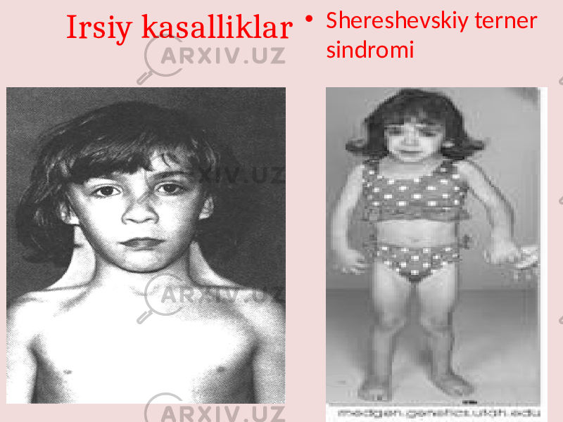 Irsiy kasalliklar • Shereshevskiy terner sindromi 