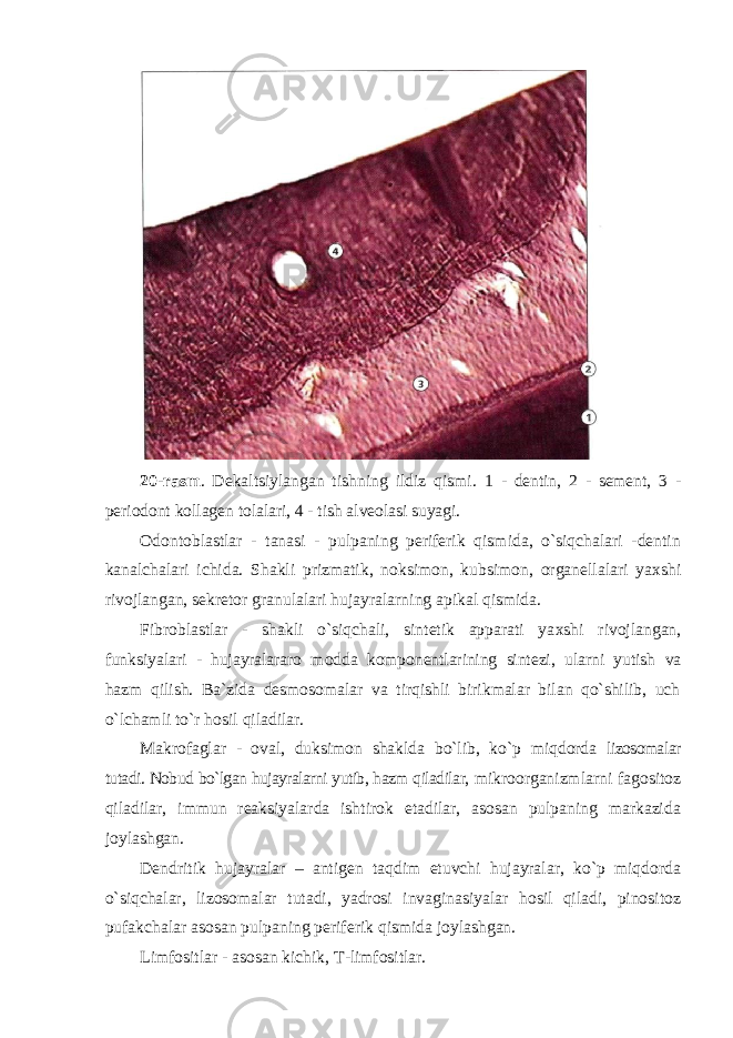 20-rasm . Dekaltsiylangan tishning ildiz qismi. 1 - dentin, 2 - sement, 3 - periodont kollagen tolalari, 4 - tish alveolasi suyagi. Odontoblastlar - tanasi - pulpaning periferik qismida, o`siqchalari -dentin kanalchalari ichida. Shakli prizmatik, noksimon, kubsimon, organellalari ya х shi rivojlangan, sekretor granulalari hujayralarning apikal qismida. Fibroblastlar - shakli o`siqchali, sintetik apparati ya х shi rivojlangan, funksiyalari - hujayralararo modda komponentlarining sintezi, ularni yutish va hazm qilish. Ba`zida desmosomalar va tirqishli birikmalar bilan qo`shilib, uch o`lchamli to`r hosil qiladilar. Makrofaglar - oval, duksimon shaklda bo`lib, ko`p miqdorda lizosomalar tutadi. Nobud bo`lgan hujayralarni yutib, hazm qiladilar, mikroorganizmlarni fagositoz qiladilar, immun reaksiyalarda ishtirok etadilar, asosan pulpaning markazida joylashgan. Dendritik hujayralar – antigen taqdim etuvchi hujayralar, ko`p miqdorda o`siqchalar, lizosomalar tutadi, yadrosi invaginasiyalar hosil qiladi, pinositoz pufakchalar asosan pulpaning periferik qismida joylashgan. Limfositlar - asosan kichik, T-limfositlar. 