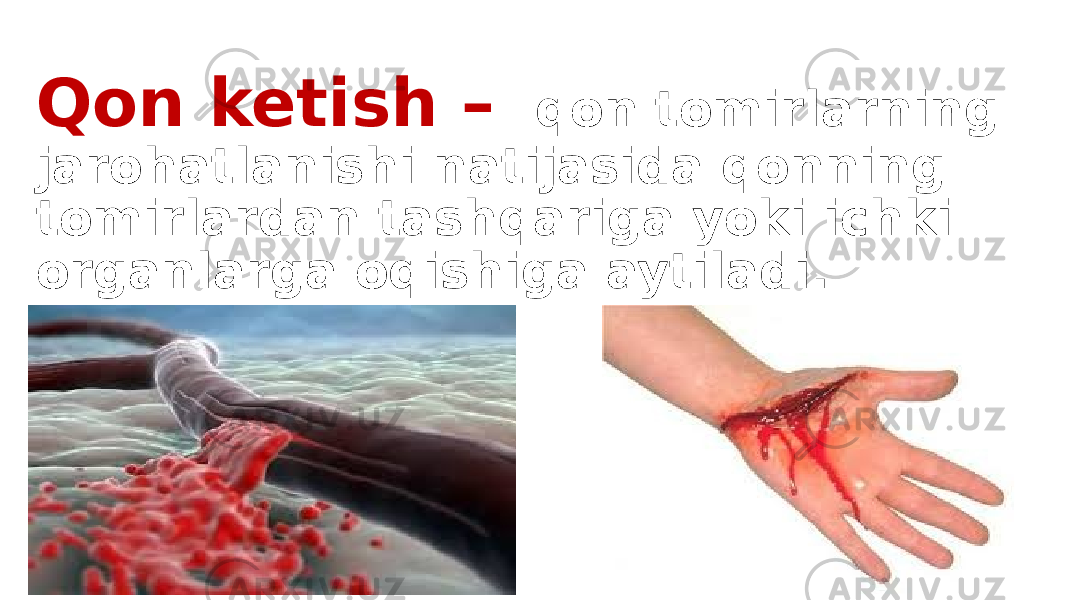 Qon ketish – qon tomirlarning jarohatlanishi natijasida qonning tomirlardan tashqariga yoki ichki organlarga oqishiga aytiladi. 