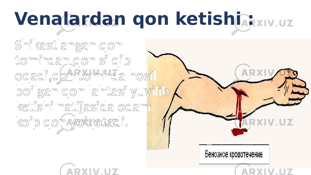 Venalardan qon ketishi : Shikastlangan qon tomirdan qon silqib oqadi,qon tomirda hosil bo’lgan qon lahtasi yuvilib ketishi natijasida odam ko’p qon yo’qotadi. 