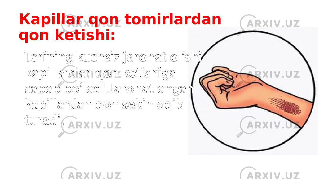 Кapillar qon tomirlardan qon ketishi: Terining kuchsiz jarohat olishi kapillardan qon ketishiga sabab bo’ladi.Jarohatlangan kapillardan qon sekin oqib turadi. 