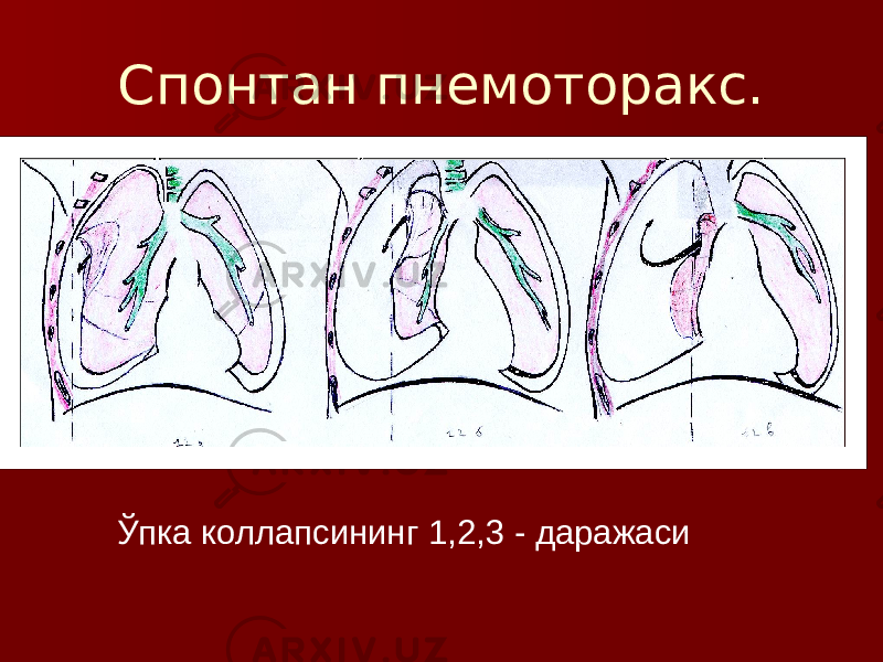 Спонтан пнемоторакс. Ўпка коллапсининг 1,2,3 - даражаси 