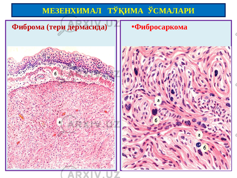  Фиброма (тери дермасида) • ФибросаркомаМЕЗЕНХИМАЛ ТЎҚИМА ЎСМАЛАРИ 
