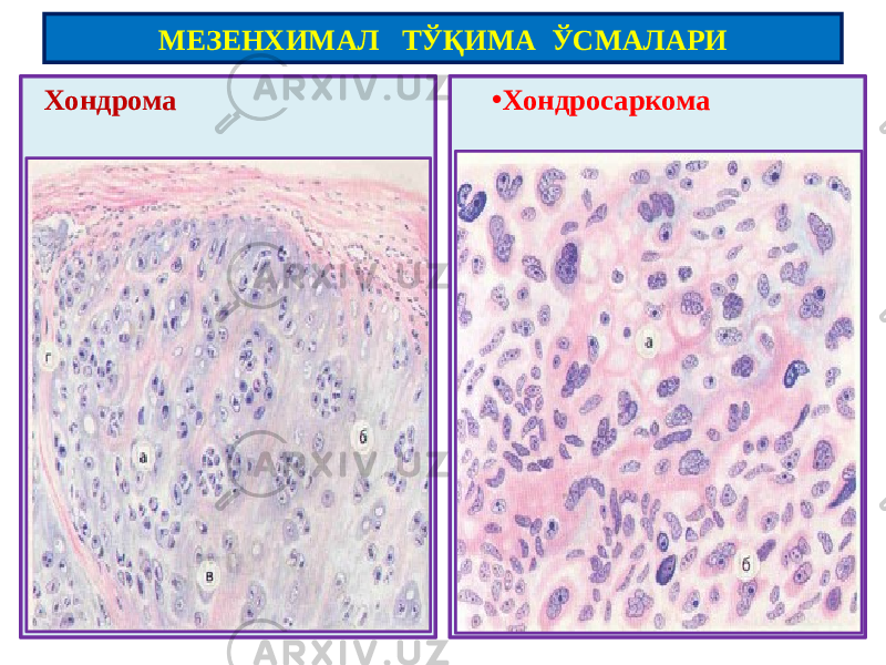  Хондрома • ХондросаркомаМЕЗЕНХИМАЛ ТЎҚИМА ЎСМАЛАРИ 