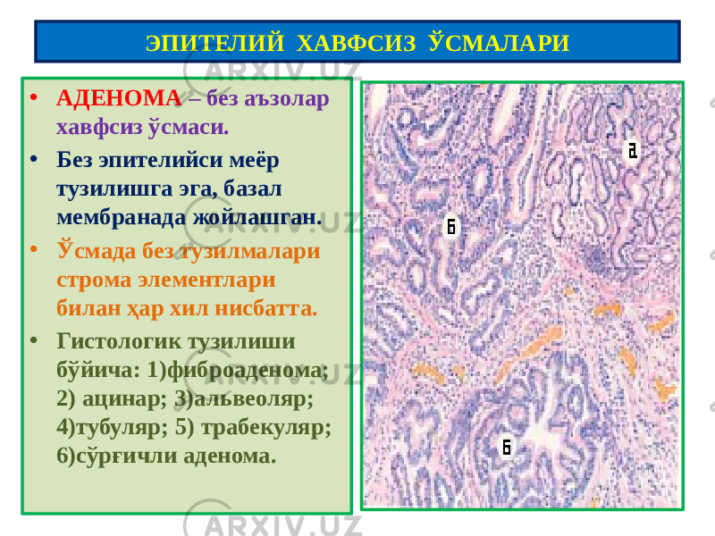 • АДЕНОМА – без аъзолар хавфсиз ўсмаси. • Без эпителийси меёр тузилишга эга, базал мембранада жойлашган. • Ўсмада без тузилмалари строма элементлари билан ҳар хил нисбатта. • Гистологик тузилиши бўйича: 1)фиброаденома; 2) ацинар; 3)альвеоляр; 4)тубуляр; 5) трабекуляр; 6)сўрғичли аденома. ЭПИТЕЛИЙ ХАВФСИЗ ЎСМАЛАРИ 