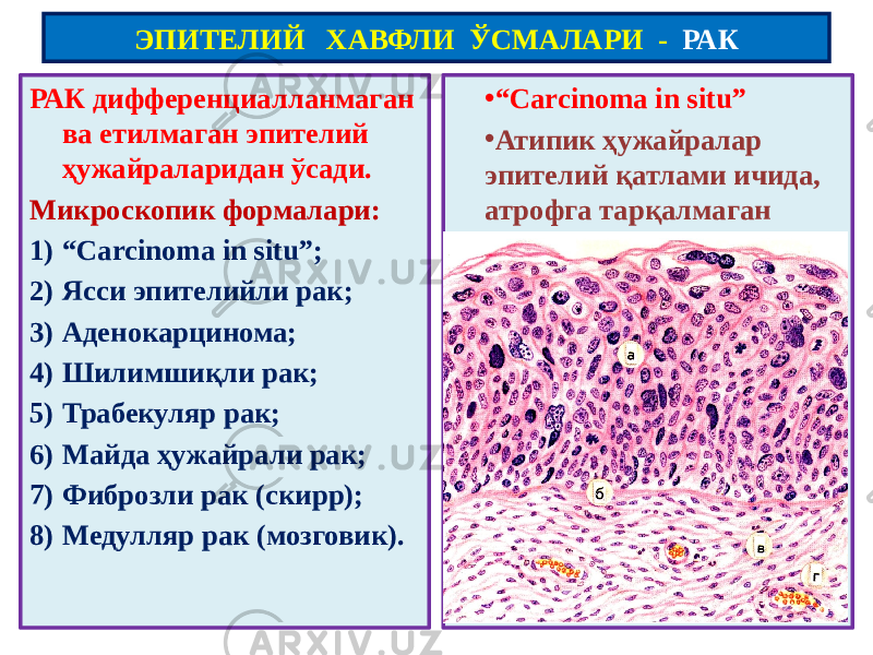 РАК дифференциалланмаган ва етилмаган эпителий ҳужайраларидан ўсади. Микроскопик формалари: 1) “ Carcinoma in situ”; 2) Ясси эпителийли рак; 3) Аденокарцинома; 4) Шилимшиқли рак; 5) Трабекуляр рак; 6) Майда ҳужайрали рак; 7) Фиброзли рак (скирр); 8) Медулляр рак (мозговик). • “ Carcinoma in situ” • Атипик ҳужайралар эпителий қатлами ичида, атрофга тарқалмаганЭПИТЕЛИЙ ХАВФЛИ ЎСМАЛАРИ - РАК 