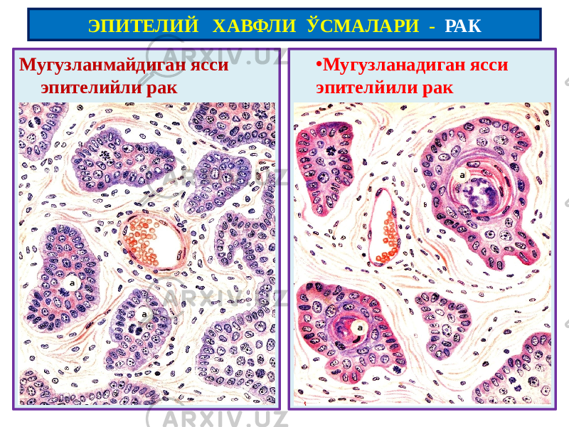 Мугузланмайдиган ясси эпителийли рак • Мугузланадиган ясси эпителйили ракЭПИТЕЛИЙ ХАВФЛИ ЎСМАЛАРИ - РАК 