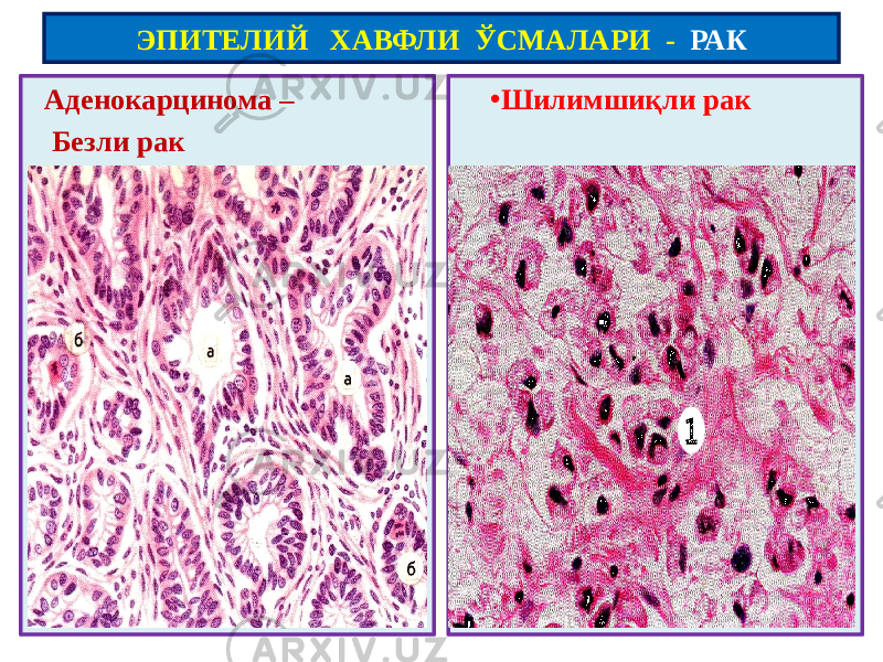  Аденокарцинома – Безли рак • Шилимшиқли рак ЭПИТЕЛИЙ ХАВФЛИ ЎСМАЛАРИ - РАК 