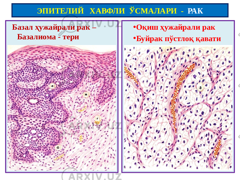  Базал ҳужайрали рак – Базалиома - тери • Оқиш ҳужайрали рак • Буйрак пўстлоқ қавати ЭПИТЕЛИЙ ХАВФЛИ ЎСМАЛАРИ - РАК 