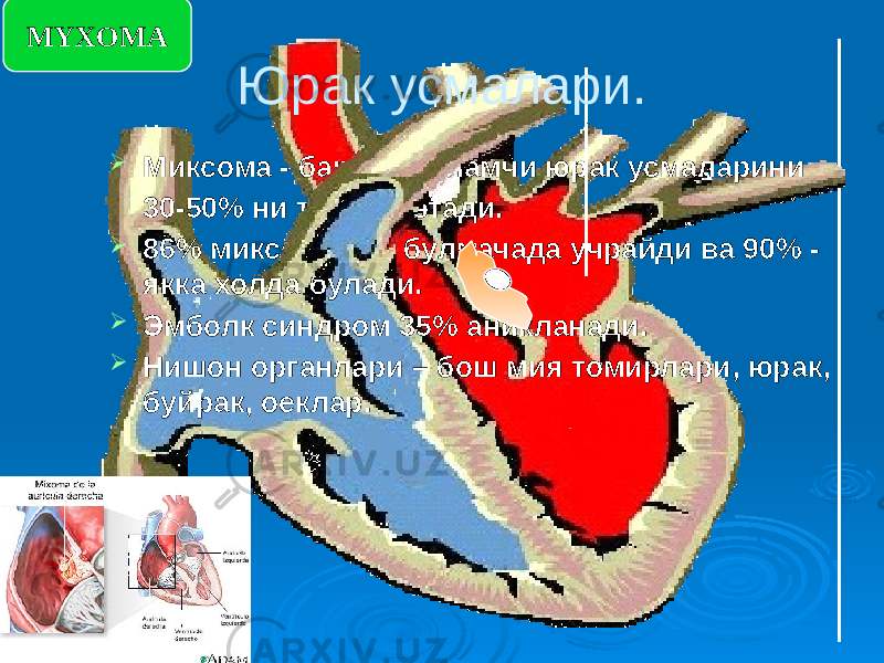  Миксома - барча бирламчи юрак усмаларини 30-50% ни ташкил этади.  86% миксома чап булмачада учрайди ва 90% - якка холда булади.  Эмболк синдром 35% аникланади.  Нишон органлари – бош мия томирлари, юрак, буйрак, оеклар. Юрак усмалари.MYXOMA 