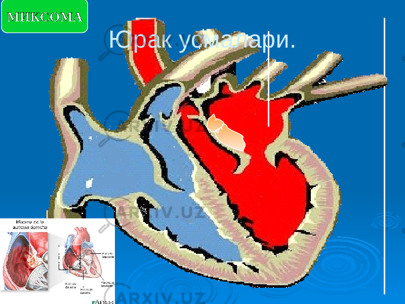 MИКСОМА Юрак усмалари. 