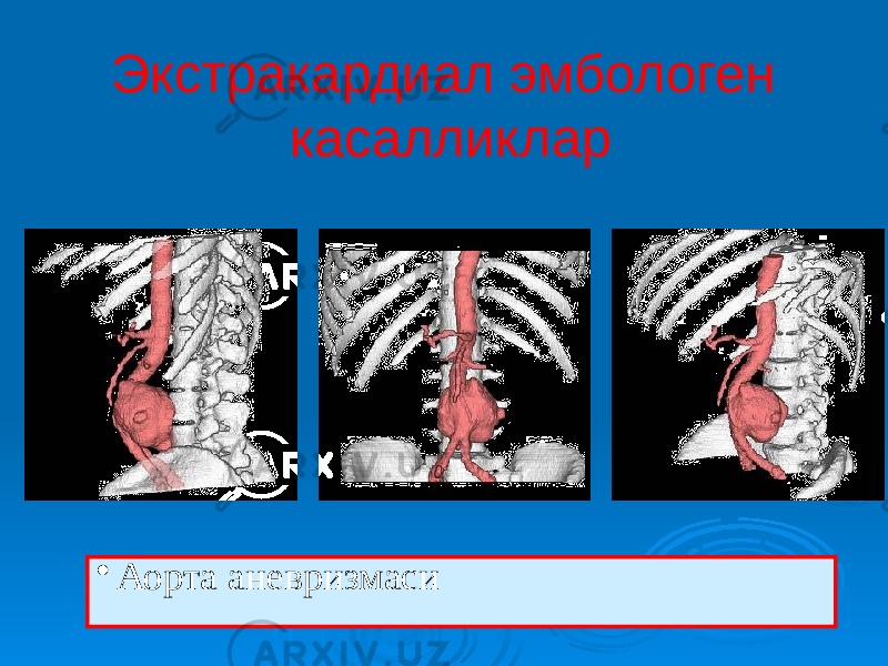 Экстракардиал эмбологен касалликлар • Аорта аневризмаси 