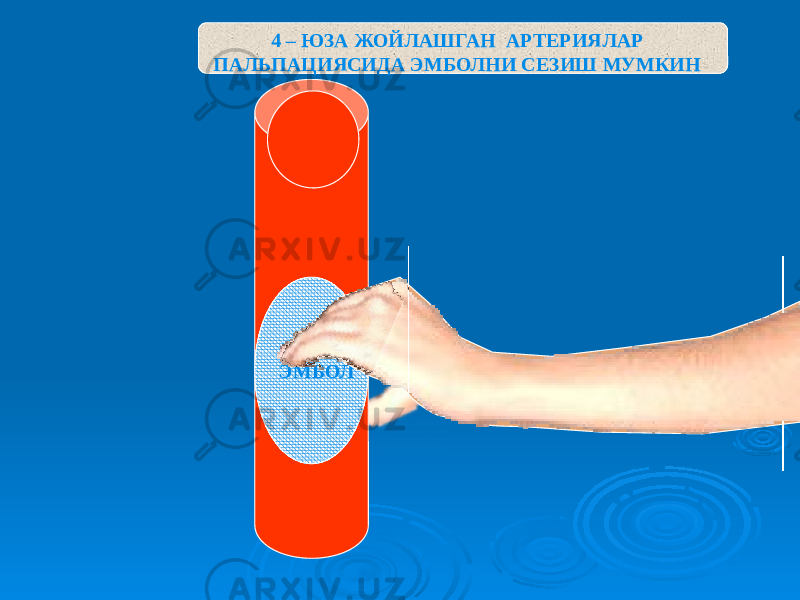 ЭМБОЛ4 – ЮЗА ЖОЙЛАШГАН АРТЕРИЯЛАР ПАЛЬПАЦИЯСИДА ЭМБОЛНИ СЕЗИШ МУМКИН 