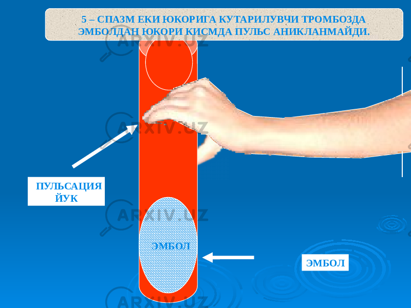 5 – СПАЗМ ЕКИ ЮКОРИГА КУТАРИЛУВЧИ ТРОМБОЗДА ЭМБОЛДАН ЮКОРИ КИСМДА ПУЛЬС АНИКЛАНМАЙДИ. ЭМБОЛ ПУЛЬСАЦИЯ ЙУК ЭМБОЛ 