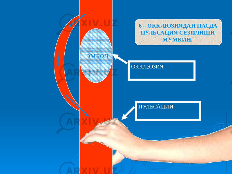 ЭМБОЛ 6 – ОККЛЮЗИЯДАН ПАСДА ПУЛЬСАЦИЯ СЕЗИЛИШИ МУМКИН.` ОККЛЮЗИЯ ПУЛЬСАЦИИ 