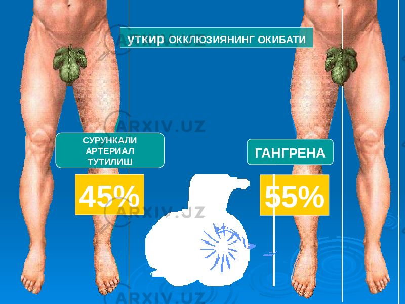 55%ГАНГРЕНА 45% СУРУНКАЛИ АРТЕРИАЛ ТУТИЛИШ уткир ОККЛЮЗИЯНИНГ ОКИБАТИ 