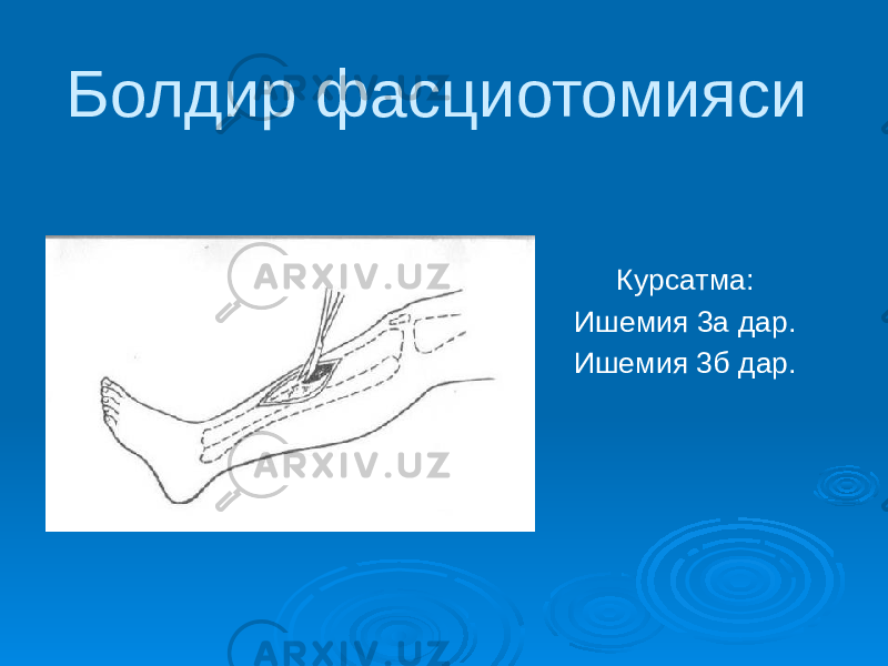 Болдир фасциотомияси Курсатма: Ишемия 3а дар. Ишемия 3б дар. 