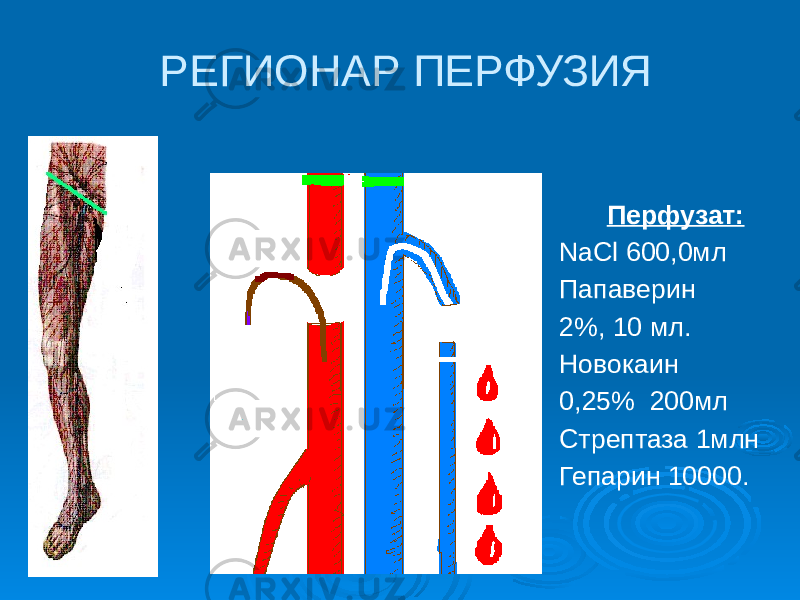 РЕГИОНАР ПЕРФУЗИЯ Перфузат: NaCl 600,0мл Папаверин 2%, 10 мл. Новокаин 0,25% 200мл Стрептаза 1млн Гепарин 10000. АИК 