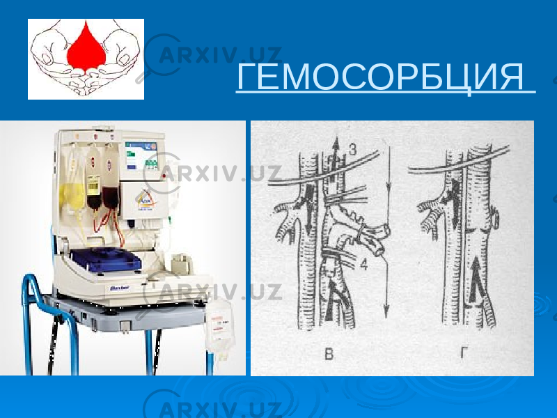 ГЕМОСОРБЦИЯ 