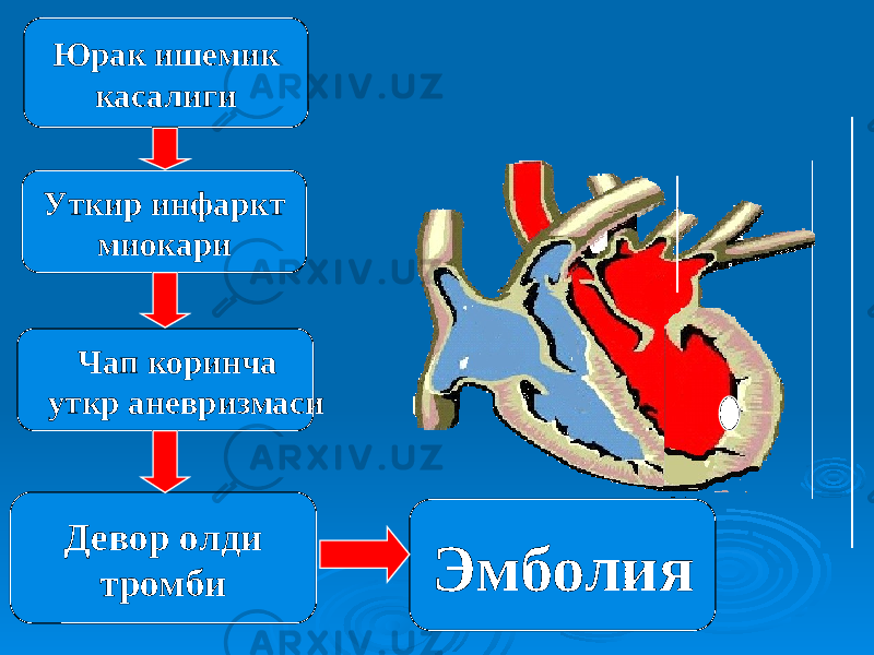 Уткир инфаркт миокариЮрак ишемик касалиги Чап коринча уткр аневризмаси Девор олди тромби Эмболия 