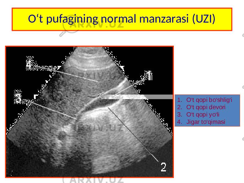 O‘t pufagining normal manzarasi (UZI) 1. O‘t qopi bo‘shlig‘i 2. O‘t qopi devori 3. O‘t qopi yo‘li 4. Jigar to‘qimasi 