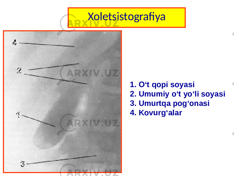 Xoletsistografiya 1. O‘t qopi soyasi 2. Umumiy o‘t yo‘li soyasi 3. Umurtqa pog‘onasi 4. Kovurg‘alar 