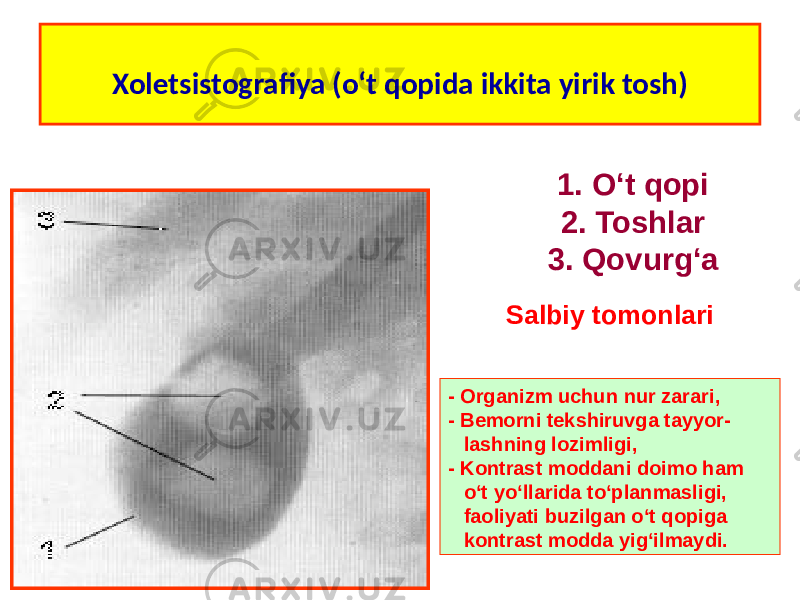 Xoletsistografiya (o‘t qopida ikkita yirik tosh) 1. O‘t qopi 2. Toshlar 3. Qovurg‘a - Organizm uchun nur zarari, - Bemorni tekshiruvga tayyor- lashning lozimligi, - Kontrast moddani doimo ham o‘t yo‘llarida to‘planmasligi, faoliyati buzilgan o‘t qopiga kontrast modda yig‘ilmaydi. Salbiy tomonlari 